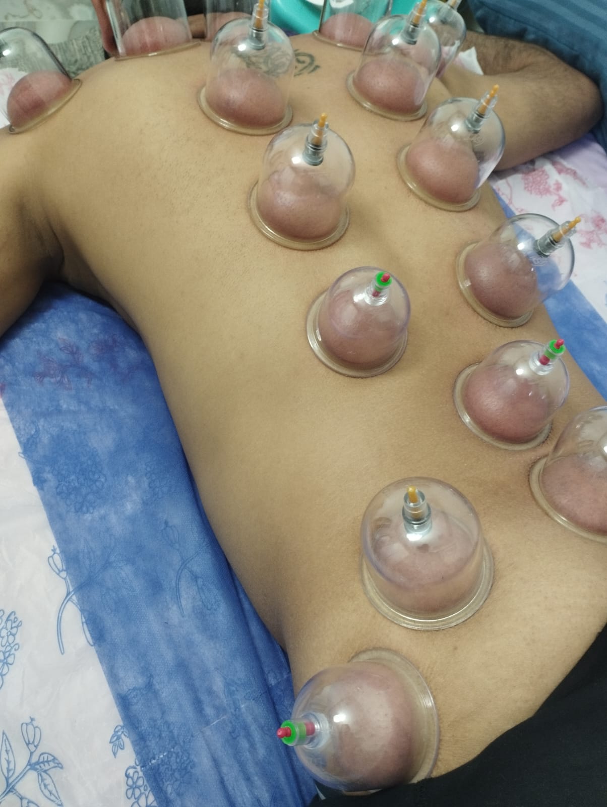 من أعمال Home Medicine - جلسة حجامة 2