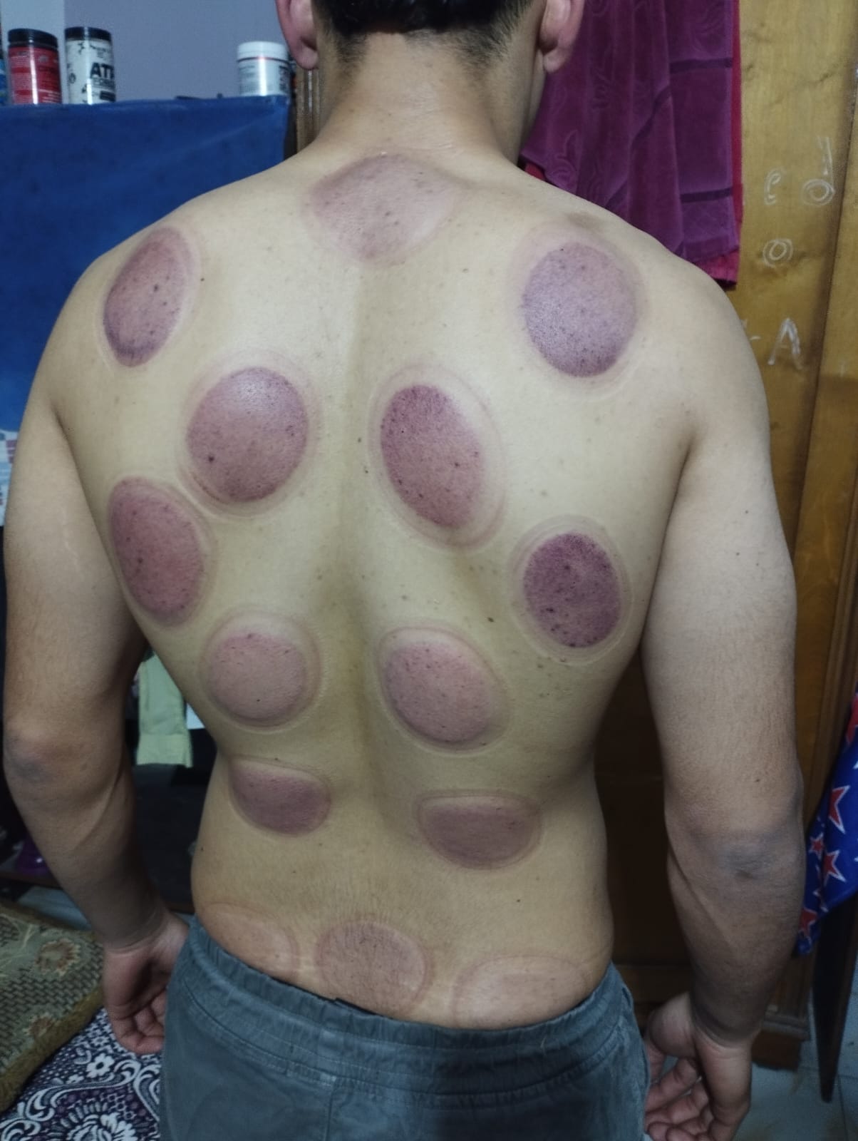 من أعمال Home Medicine - جلسة حجامة 4
