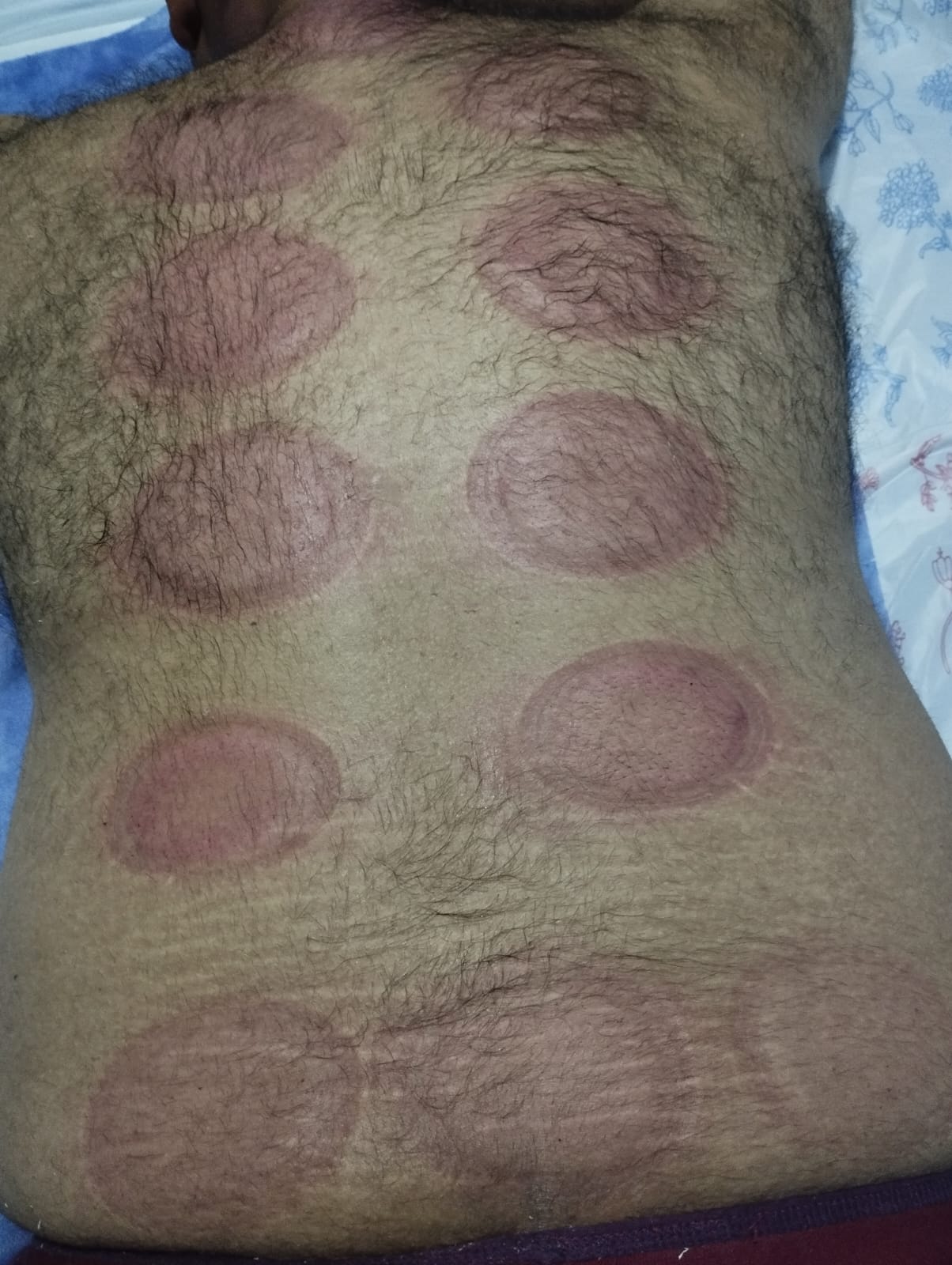 من أعمال Home Medicine - جلسة حجامة 5