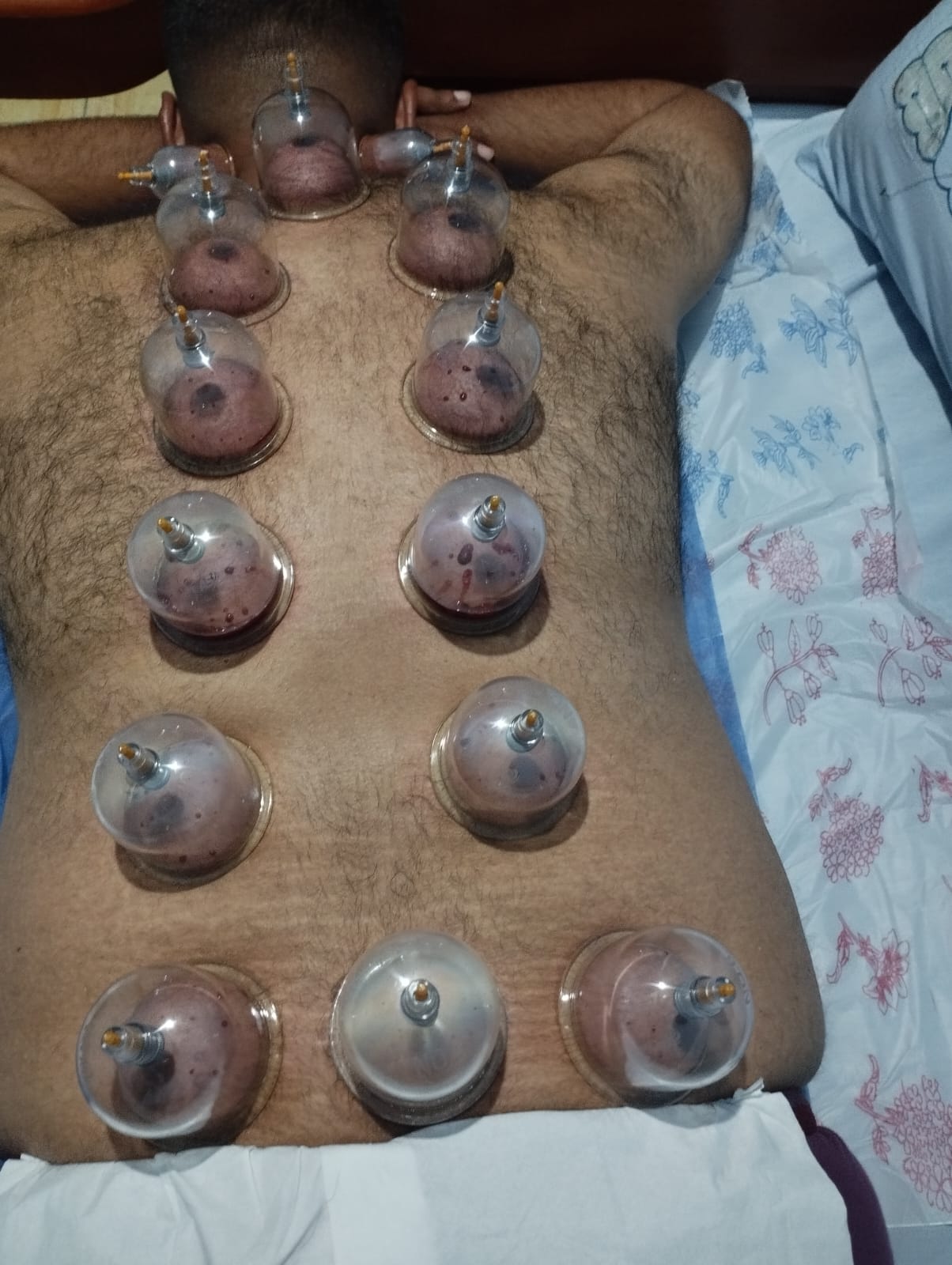 من أعمال Home Medicine - جلسة حجامة 6