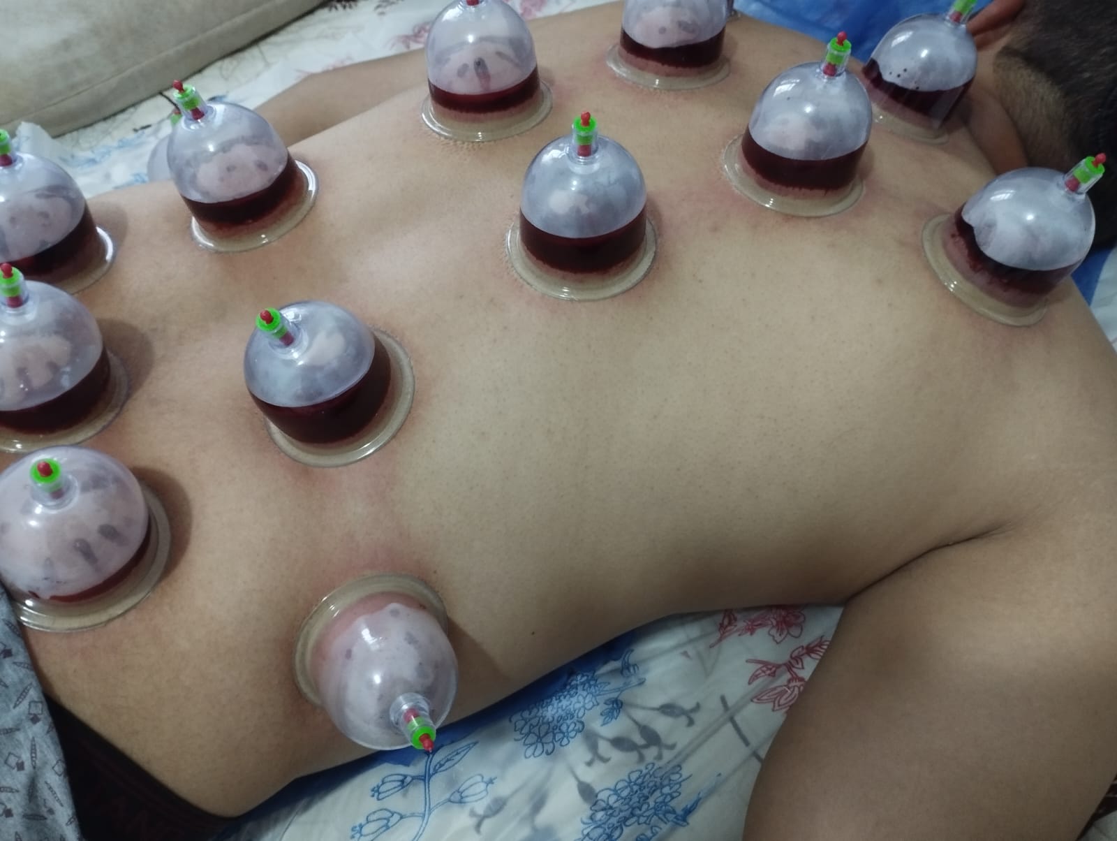 من أعمال Home Medicine - جلسة حجامة 9